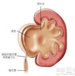 肾积水的症状,识别与应对策略